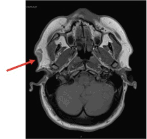 Axial T1-weighted image demonstrating a well-circumscribed lesion (arrow) within the superficial soft tissues, appearing hyperintense to muscle
