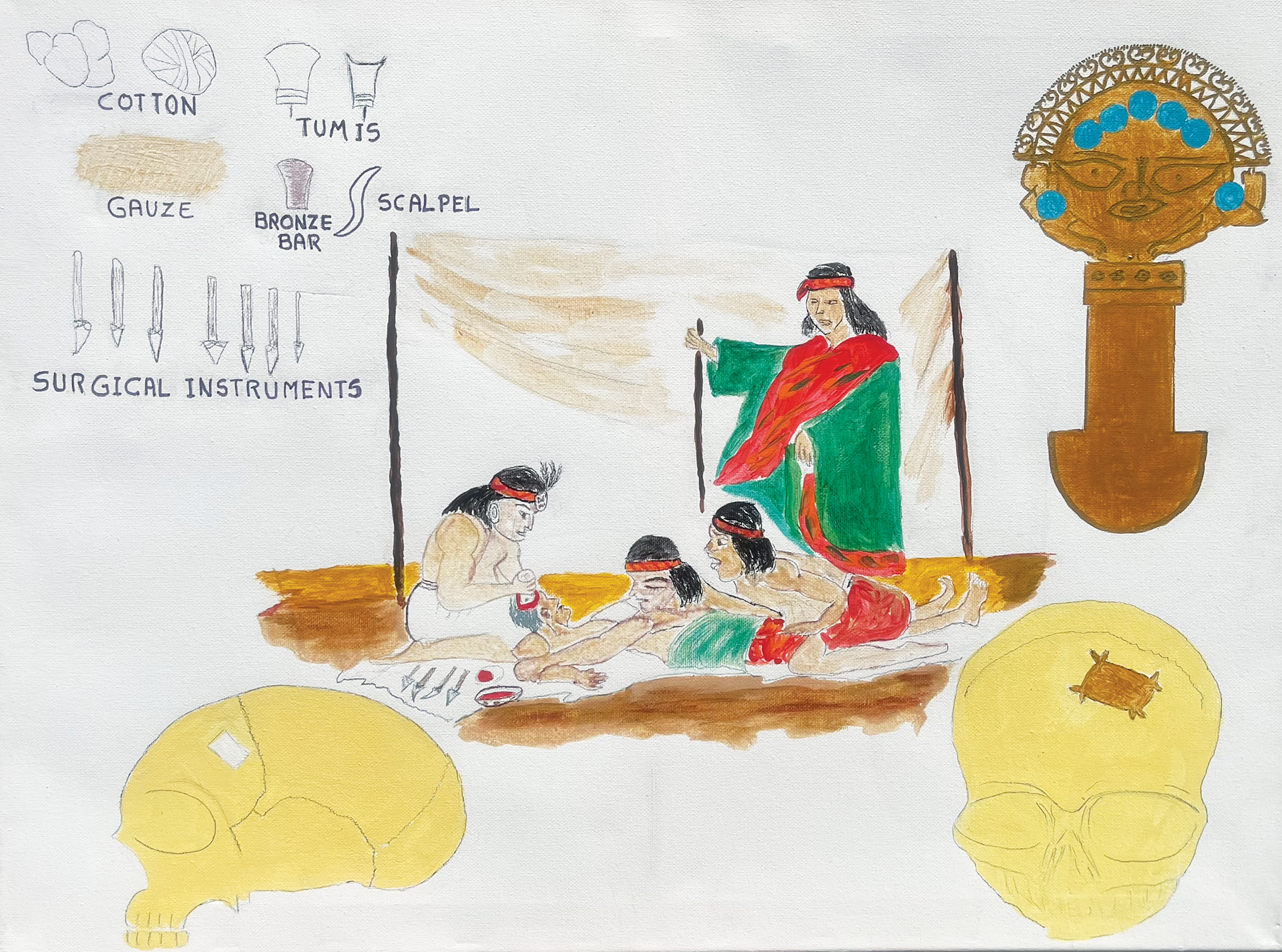 Artist Gladys R. Sanchez depicts Inca surgeons performing trepanation, along with tools, tumis, trepanned skulls, and gold cranioplasty 
