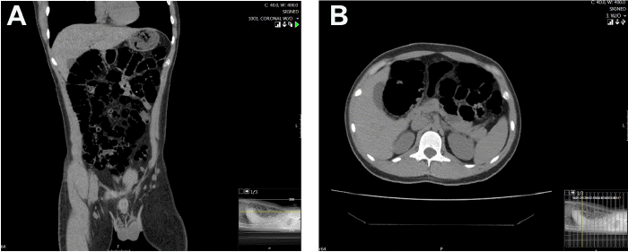 CT imaging without contrast was conducted shortly following patient presentation and revealed a slightly distended stomach, normal bowel caliber, and moderate gas and stool. The foreign body was not visualized on A) axial or B) coronal imaging and no evidence of free air or fluid was noted