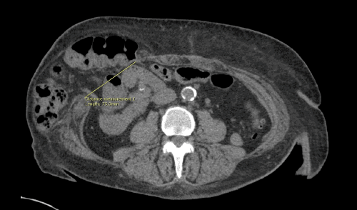 Preoperative axial CT scan obtained approximately two years following kidney transplantation, demonstrating a large ventral hernia defect (measuring approximately 7.5 cm in transverse dimension on this image) containing loops of small and large bowel, situated in the region of her transplanted kidney