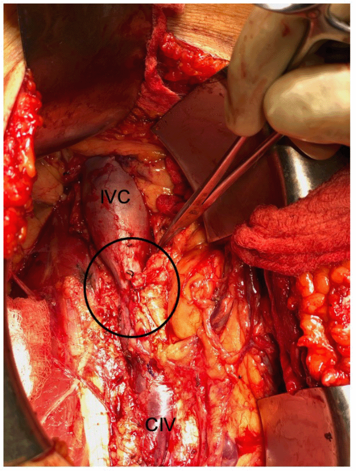 Retroperitoneal exposure of the infrarenal IVC obstruction (circled) and common iliac vein (CIV)