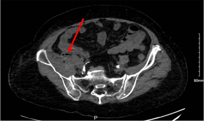 CT Abdomen and Pelvis showing small bubbles of gas and heterogeneity of the psoas muscle