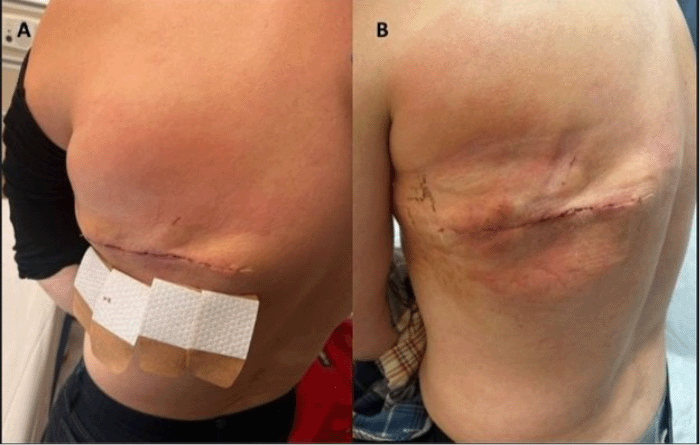 Clinical photographs demonstrating the healed surgical site. (A) Appearance on POD 6 and (B) POD 8 following definitive wide local excision and complex closure by the surgical and plastic surgery teams