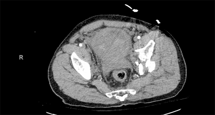 Scattered heterogeneous debris noted within the urinary bladder
