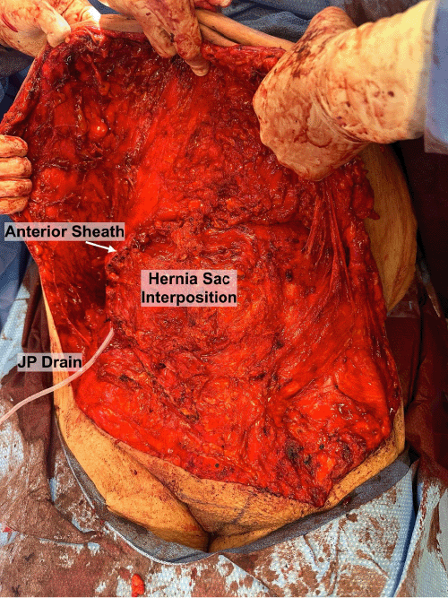 Intraoperative photograph showing the closure of the anterior rectus sheath. Note the use of the hernia sac as an interposition flap between fascial edges where primary approximation was not tension-free, ensuring complete coverage of the underlying mesh. A JP drain is visible overlying the mesh