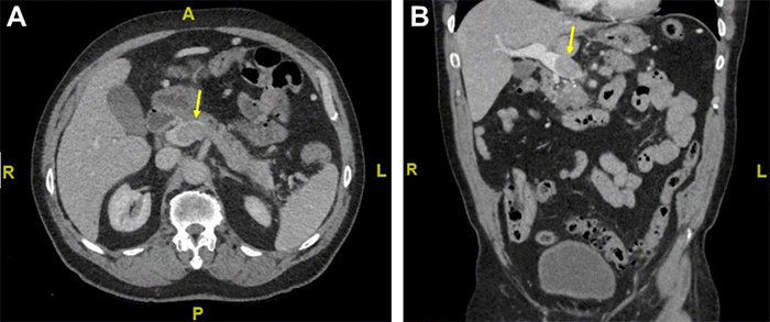 Scan depicts a filling defect at the splenoportal confluence, consistent with a tumor thrombus (arrows). The filling defect extends proximally to the level of the inferior mesenteric vein (not visualized in this image)