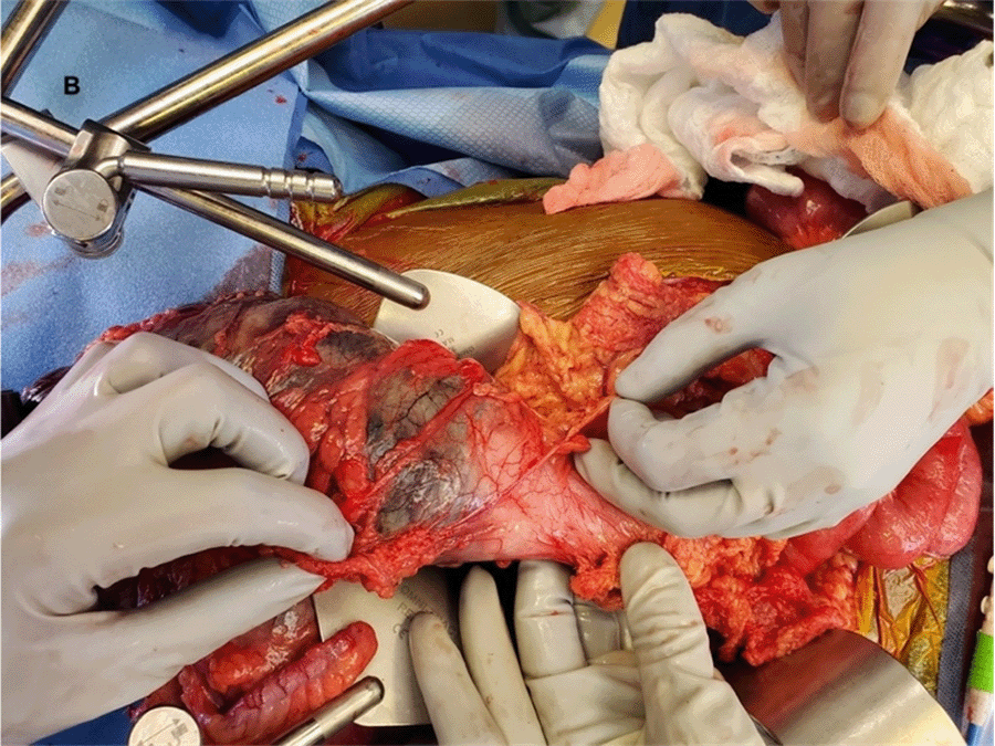 B) a clear demarcation of the border of ischemic colon is seen.
