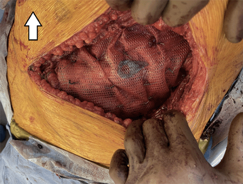 B) overlay mesh (arrow points cranial)