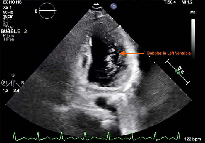 The image captures the appearance of microbubbles (arrow) within the left ventricle shortly after opacification of the right heart chambers, confirming a right-to-left shunt consistent with a PFO