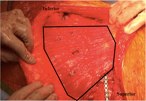 Figure 6: The image depicts the patient’s left-sided, muscle-sparing thoracotomy, with the boundaries of the latissimus dorsi muscle completely intact along with plated ribs 5 and 7 in view, superior and inferior to the muscle, respectively.