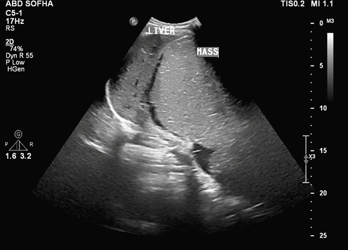 Large, well-circumscribed abdominal mass identified on initial obstetrical ultrasound examination