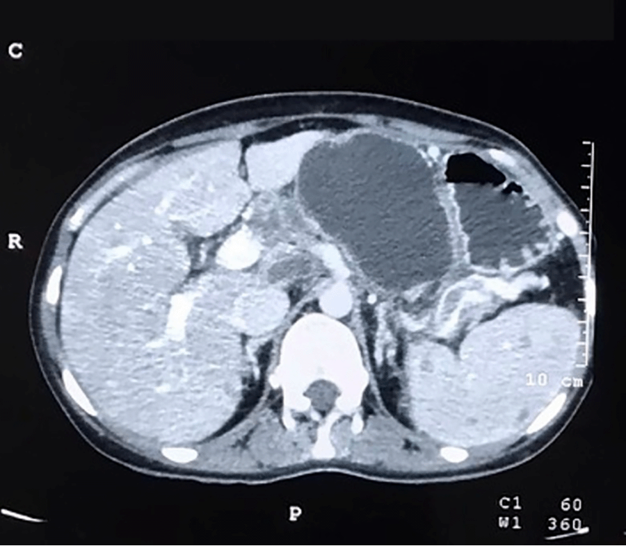 Note. Thickened unenhanced walls and absence of mural nodularity.