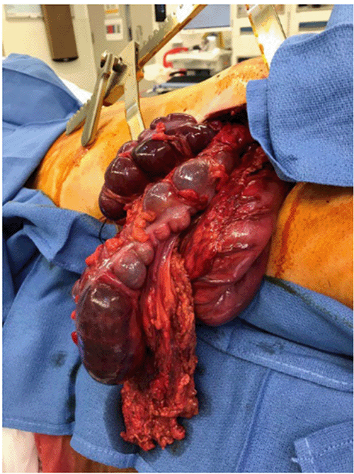 Intraoperative photograph showing ischemic colon draped over the stomach and omentum.