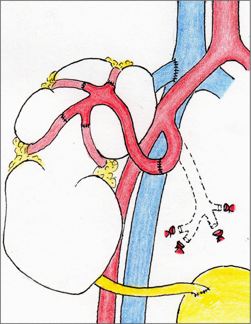 B) schematic of vascular reconstruction and implantation (illustration by Niaz Ahmed)
