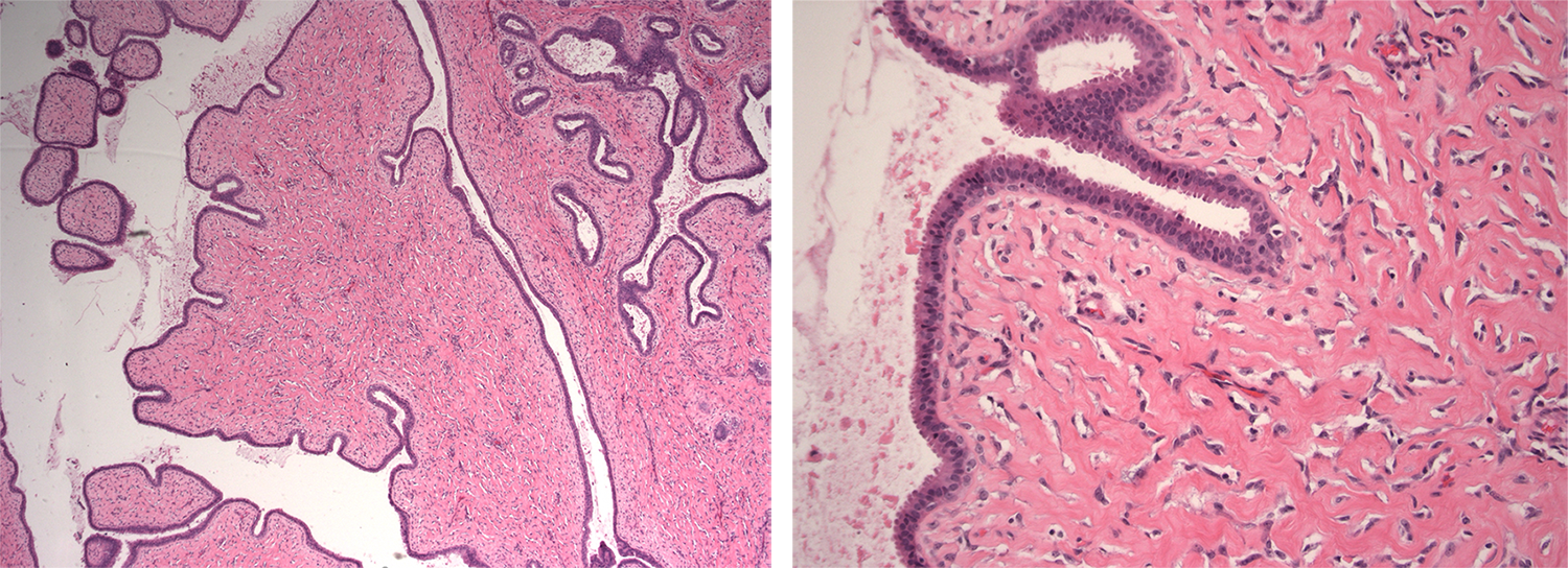Figures 1 A and B: Low-power and high-power slides from a benign phyllodes tumor in 2013