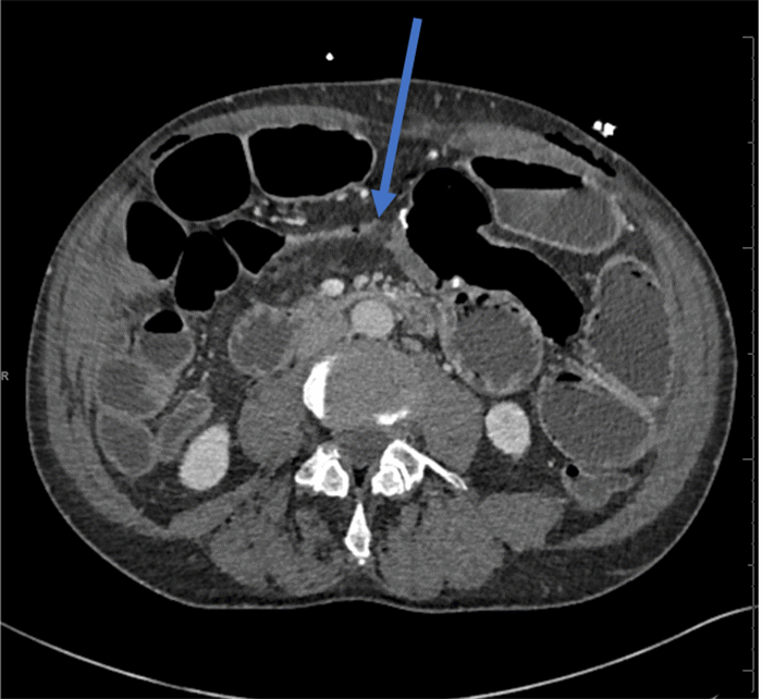 Note dilated small bowel loops and a segment of decompressed small bowel proximal to the ileocolic anastomosis (blue arrow)