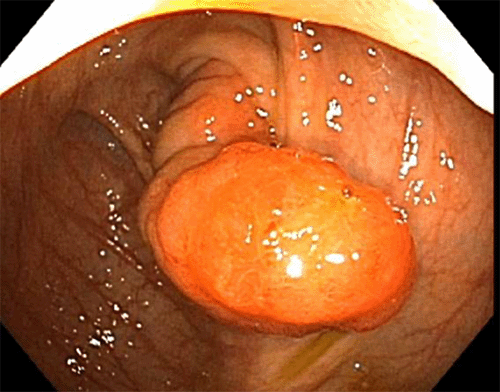 Intussusception of the Appendix Secondary to Endometriosis | ACS