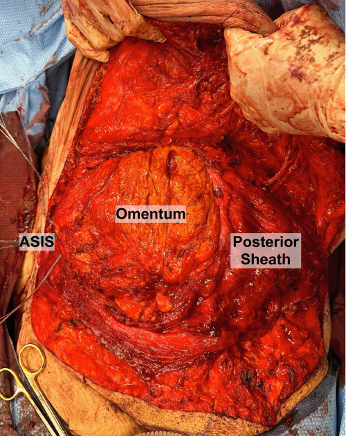 Intraoperative photograph after bilateral TAR, showing the omental flap mobilized and sutured as an interposition layer to facilitate closure over the viscera due to inability to primarily approximate the posterior rectus sheath