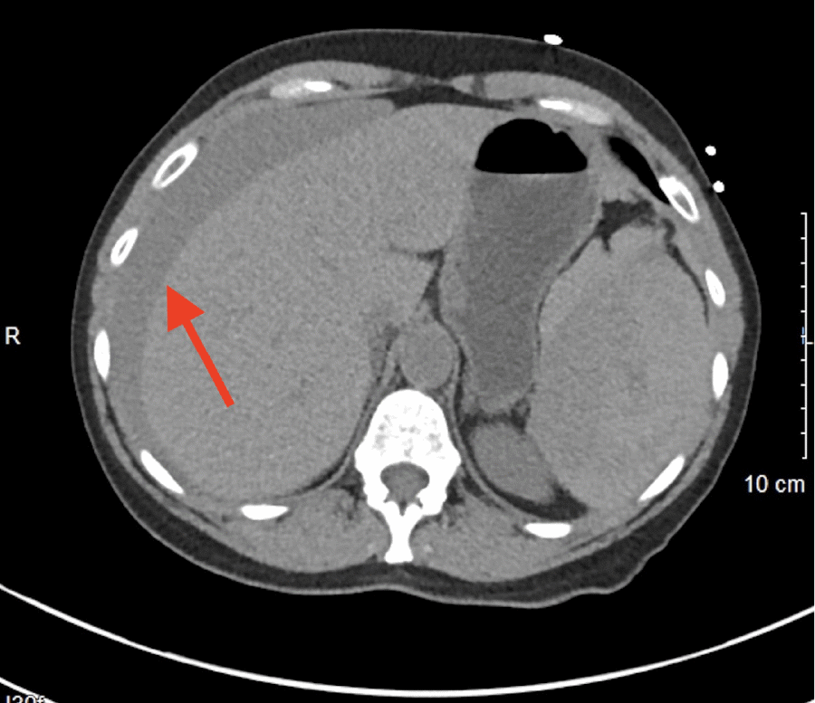 12 × 15 cm parenchymal hematoma with large halo of blood around liver (arrow).
