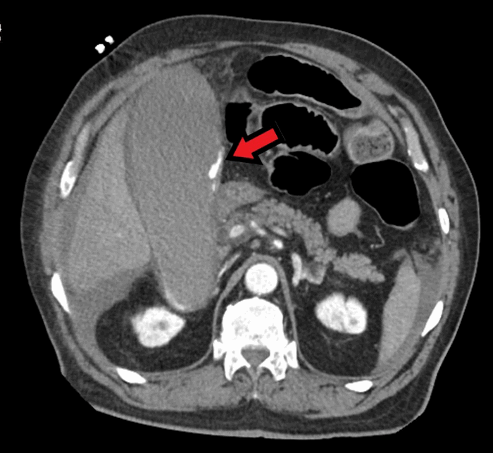 Figure 2. Distended gallbladder with intraluminal contrast suggesting active extravasation. Arrow shows a blush of contrast within gallbladder.