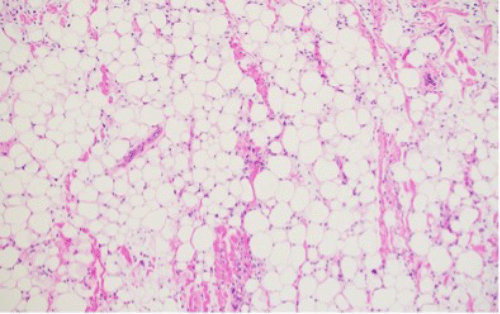 A higher-power view (100x magnification) further details the adipocytic tissue, lipoblasts, and primitive ovoid stromal cells within the myxoid stroma