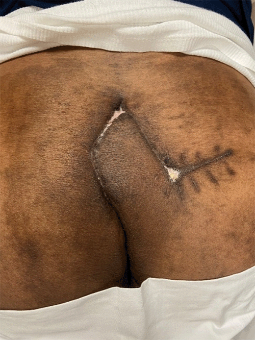 Healed rhomboid flap incision following wide local excision of squamous cell carcinoma and associated pilonidal disease