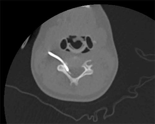 Arrow denotes catheter tip in epidural space, confirming result of contrasted port study.