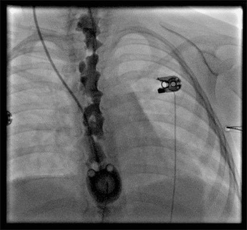 Contrast in Epidural Space