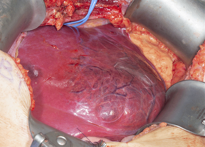Operative specimen demonstrating a 12.2 × 12.1 × 6.0 cm subcapsular lesion consistent with a mixed beta-catenin inflammatory subtype hepatocellular adenoma.