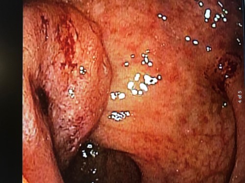 Figure 1. Colonoscopic visualization of circumferential, ulcerated rectal tumor.