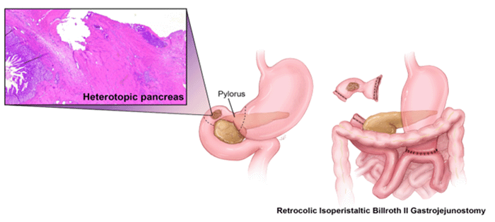 Laparoscopic rendering of the operative field demonstrating a retrocolic isoperistaltic Billroth II gastrojejunostomy after resection. Inset: histopathology confirming the presence of heterotopic pancreas near the gastric antrum