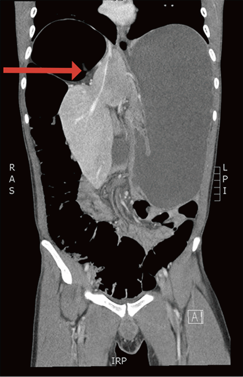 Distension of the colon and stomach with medial displacement of the liver (arrow)