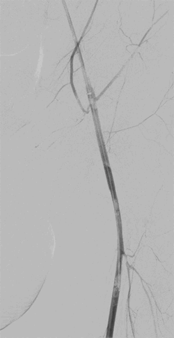 Figure 3. Angiogram after left sided stent deployment in the left common femoral artery. AVF no longer visualized.