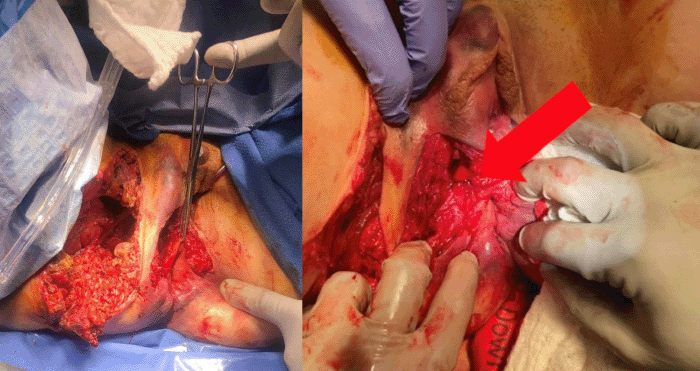 Intraoperative photographs. (Left) Reconstructed anal canal following anoplasty. (Right) Completed overlapping internal and external anal sphincteroplasties (arrow indicating imbricated sphincter muscle)