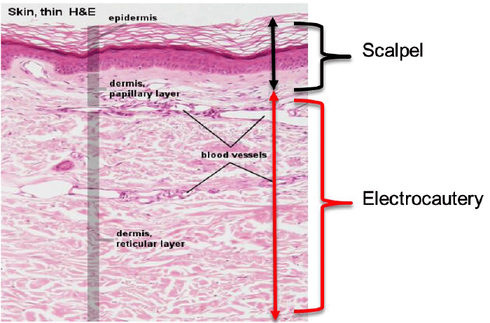 The technique is transection of the epidermis with a cold scalpel down to the papillary layer of the dermis with completion of the incision past the reticular dermis using low-setting cutting electrocautery.