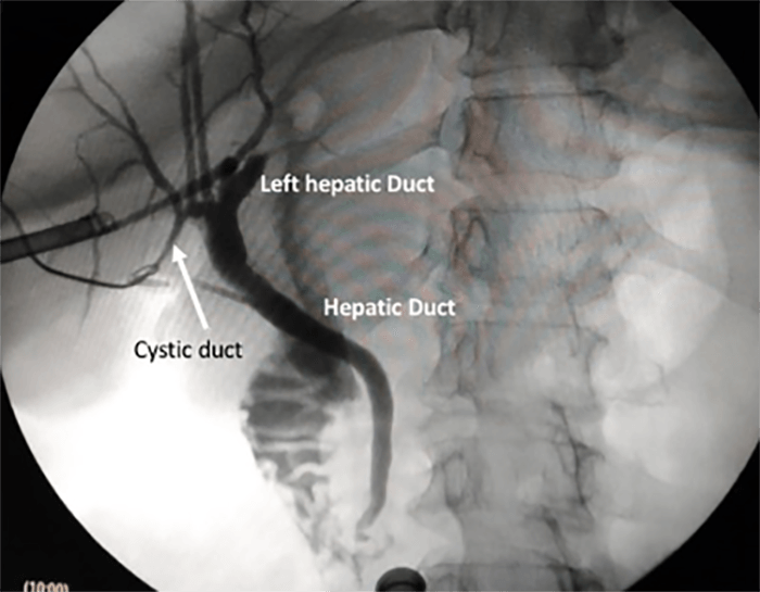 Figure 1. Intraoperative cholangiography showing cystic duct (white arrow) draining in the right hepatic duct
