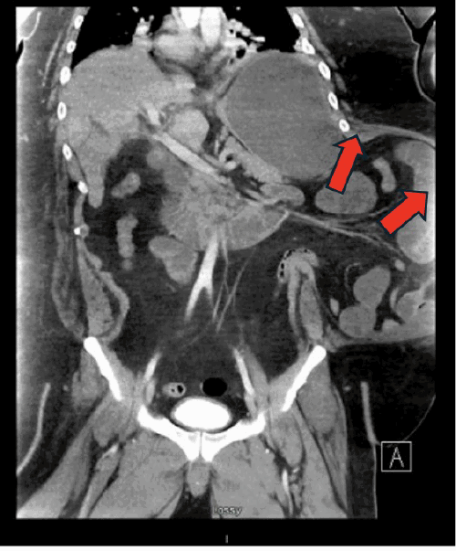 Coronal view from the initial abdominal CT scan on presentation. The images demonstrate a large, left-sided lateral ventral hernia containing bowel loops. Note the incomplete visualization of the entire hernia sac due to the patient’s body habitus, with possible early fluid accumulation noted near the subcostal margin
