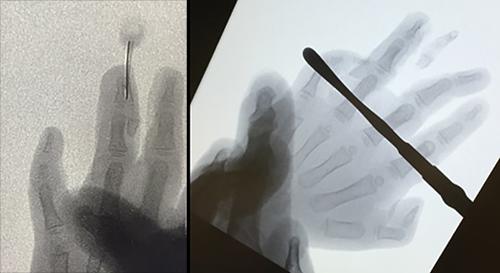 Figure 7. Intraop fluoroscopy showing the bony synostosis before and after excision.