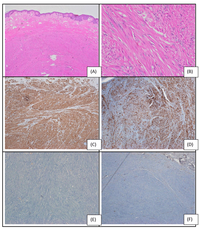 A, Microscopic examination demonstrates the lesion composed of interwoven fascicles of spindle cells with intervening collagen bundles; B, individual cells exhibit abundant eosinophilic cytoplasm, occasional vacuoles, and elongated nuclei with minimal atypia; C, D, positive staining for SMA and desmin; E, F, negative staining for pancytokeratin and myogenin