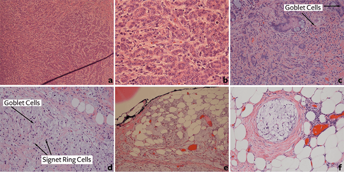 Appendiceal goblet cell carcinoids and adenocarcinomas ex-goblet cell  carcinoid are genetically distinct from primary colorectal-type  adenocarcinoma of the appendix | Modern Pathology
