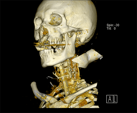 Figure 3. CT 3 dimensional reconstruction.