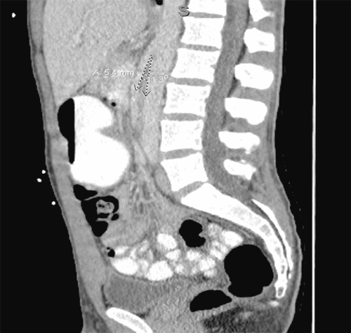 Image depicting narrowing of aortomesenteric angle, measuring 11.3 degrees and aortomesenteric distance of 5.4 mm