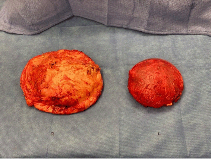 Following en bloc resection of bilateral breast implants and capsules, right capsule was noted to be significantly larger than left capsule