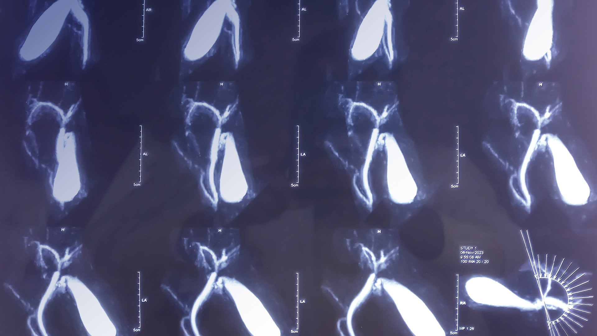 Conversations in Acute Cholecystitis Management Include Treatment Timing, Robotics