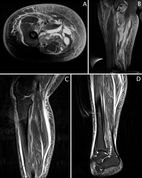 Figure 1. MRI imaging. Right thigh (A) axial and (B) sagittal STIR weighted images demonstrate multiloculated abscesses in the posterior thigh, inflammation of the adductor magnus, adductor longus, sartorius, gracilis, semimembranosus and vastus medialis. There is diffuse soft tissue edema. MRI of the right calf sagittal (C) upper calf and (D) lower calf STIR-weighted images demonstrate extensive subcutaneous and muscular edema. There is fluid within the crural fascia.