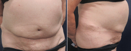 Figures 7 and 8. Ten months postoperative (5/18/2017)