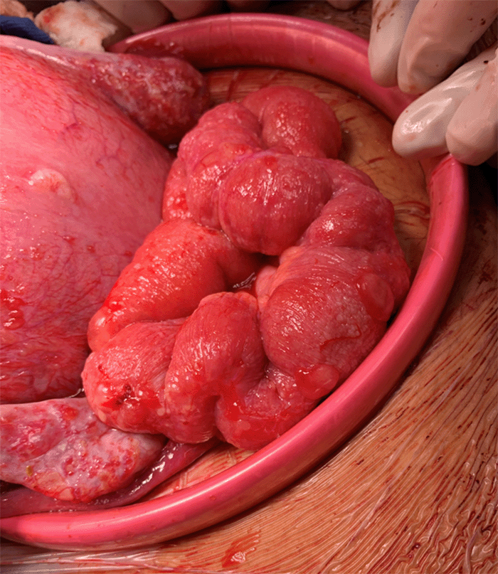 Intraoperative photo showing stromal deciduosis on the small bowel.