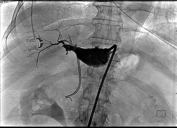 Figure 2. Tube check study through a pigtail drain in the sub-hepatic space shows communication between a biloma in the gallbladder fossa and non-dilated posterior segment 6 and 7 biliary ducts. 