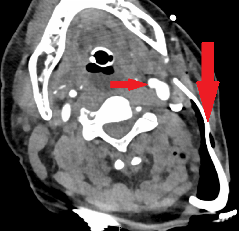 Figure 2. CT angiography of the head and neck demonstrating foreign body abutting major vasculature.