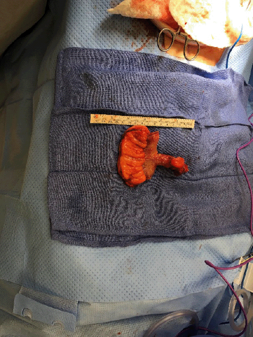 B) resected ileum with Meckel’s diverticulum present.